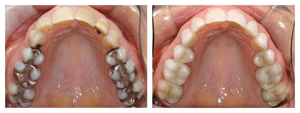 Cerec Before & After